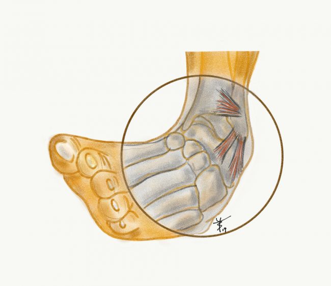 Zdj nr 1 stopy biegacza