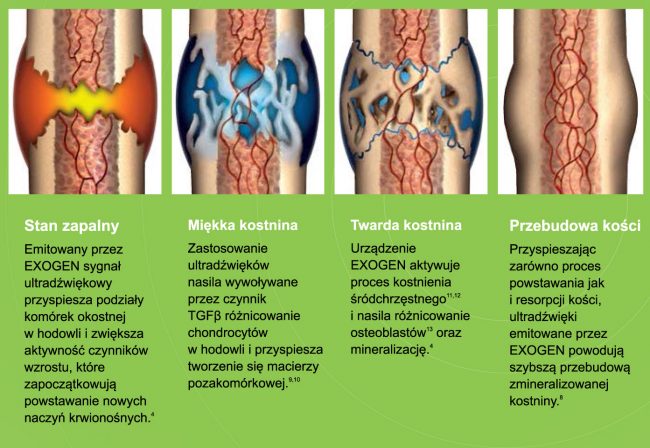 Obrazek2_Big gojenie złamań