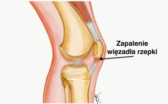 zapalenie-wiezadła-rzepki