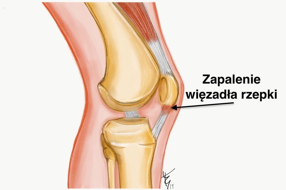 zapalenie-wiezadła-rzepki