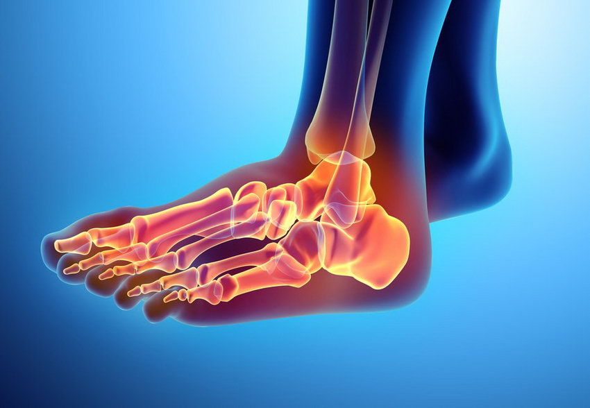 Uporczywe bóle stopy u biegaczy