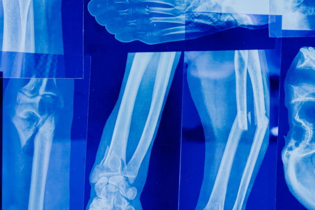złamania kości
