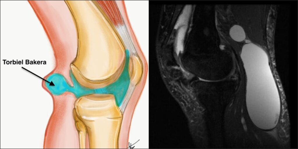 Jak się leczy cystę Bakera