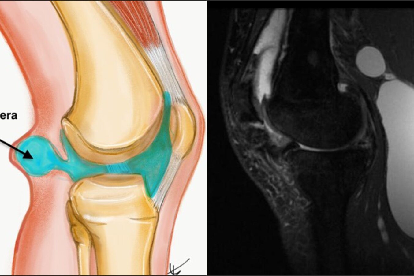 torbiel-bakera-lecznie