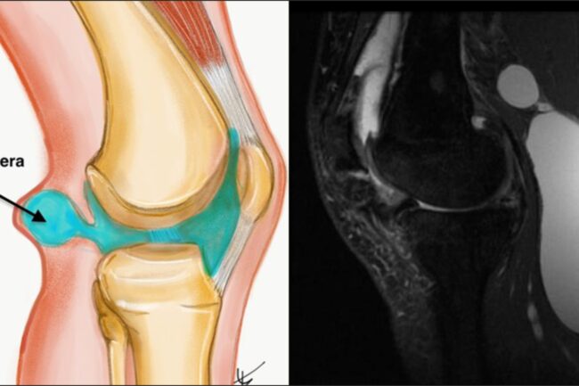 torbiel-bakera-lecznie