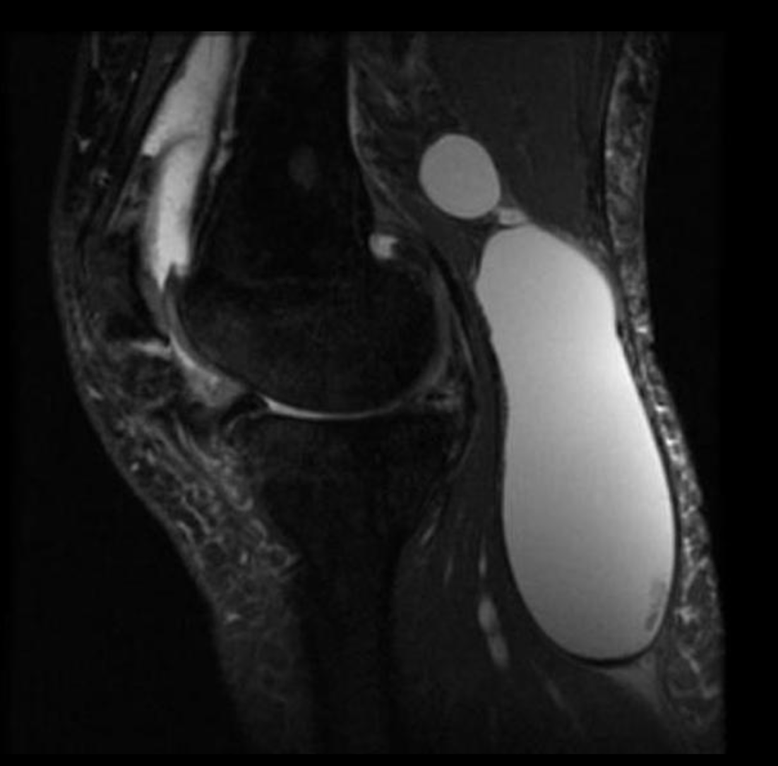 torbiel-bakera-zdjecie2