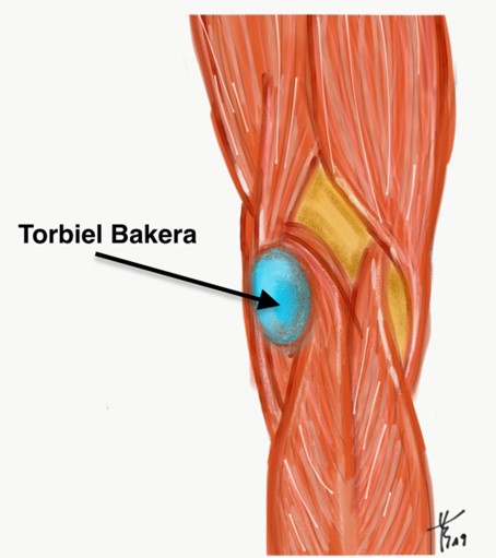 torbiel-bakera2